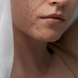 Close-up of a person's face with visible acne on a neutral background
